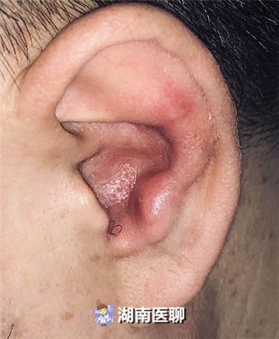 男子耳朵长泡还嘴歪误以为是中耳炎结果竟是面瘫找上门
