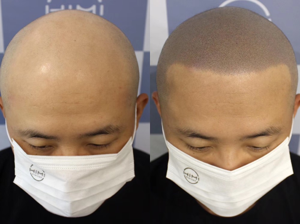 脱发的人那么多,为什么秃顶的形状都差不多