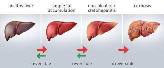 非酒精性脂肪肝|研究人员开发一种潜在的治疗非酒精性脂肪肝的方法