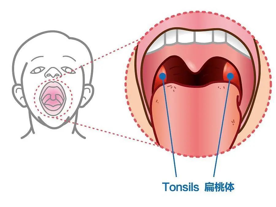 孩子一感冒就喉嚨紅腫充血該不該把扁桃體切了重慶小米熊