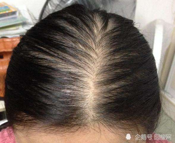 头顶头发稀疏该怎么办 五个生发方法使头发茂密|脱发|熬夜|头皮|吸烟