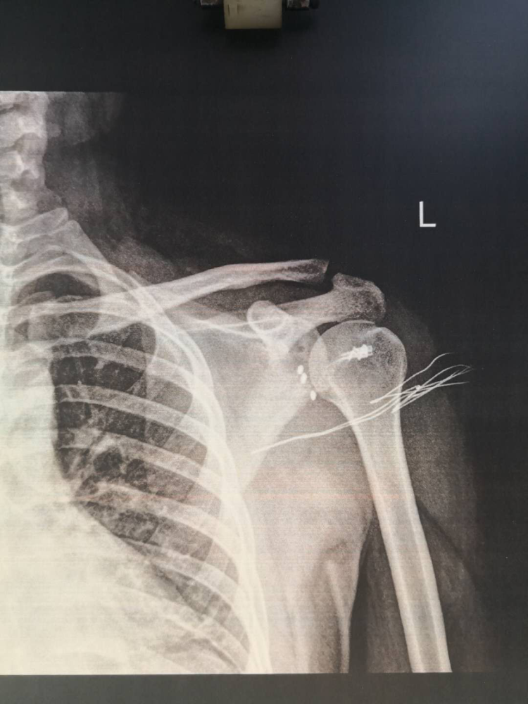 男子骑摩托不慎摔伤左肩肩关节畸形疼痛难忍专家提醒这个症状没那么