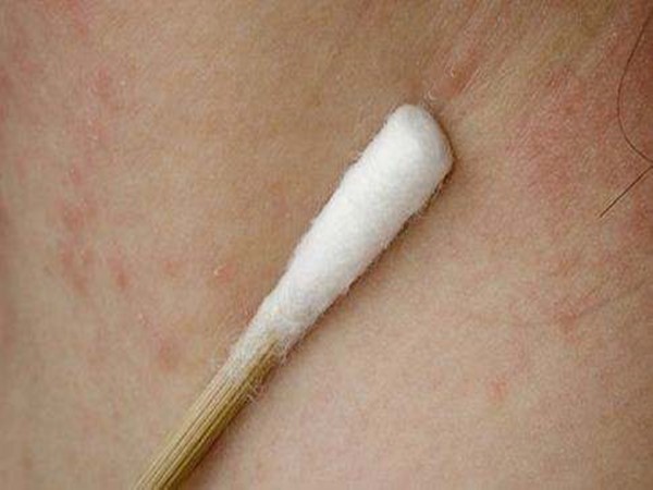 什么是麻疹,和呼吸科有关吗?