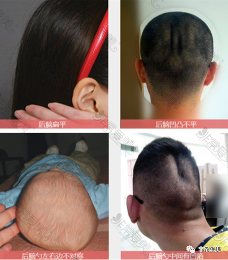 扁头矫正成功案例看扁头变圆头成功效果!_腾讯新闻