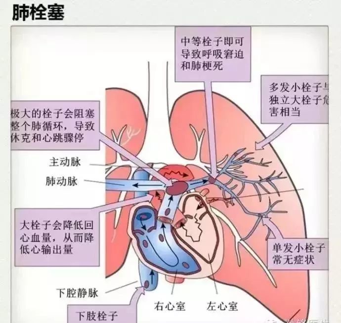 近年来,不断有双氧水运用过程中发生气体栓塞(肺栓塞,脑栓塞)和心跳