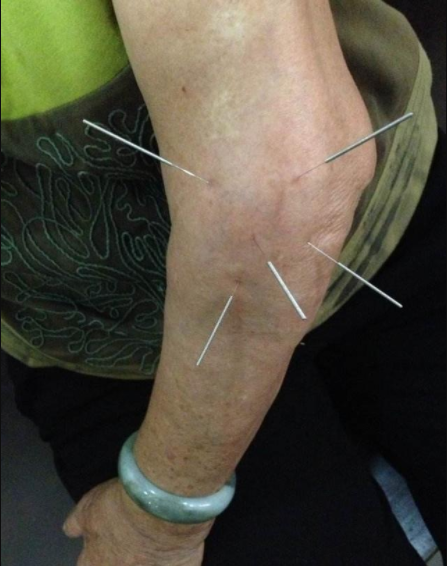 不打网球怎么也得网球肘这些方法帮你缓解疼痛