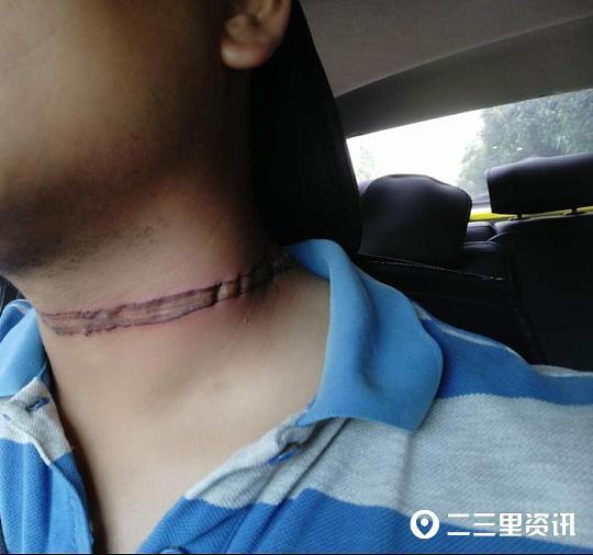 西安一男子晚上骑车被悬空电线勒住脖子,留下10厘米勒痕.