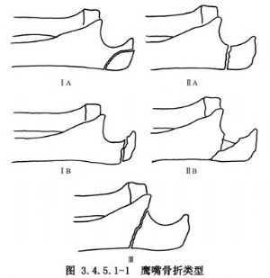 尺骨鹰嘴的症状和体征 尺骨鹰嘴骨折 尺骨 骨折不愈合