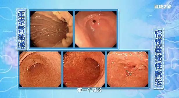 宫颈白斑图片图库图片