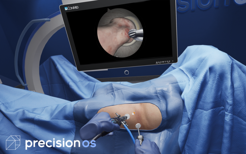 Precisionos与conmed合推便携式vr关节镜手术模拟方案 腾讯新闻