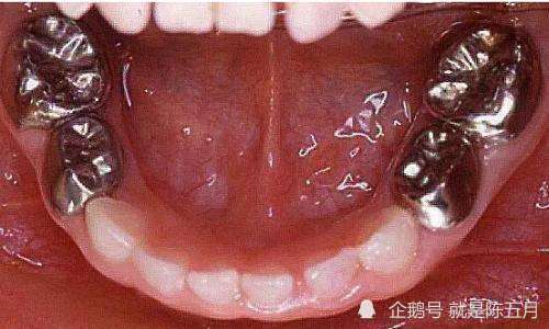 乳牙预成冠有什么作用会影响换牙吗