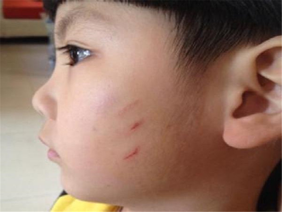 孩子上幼儿园被同学抓破脸,宝妈的处理方式,连老师都忍不住点赞_腾讯