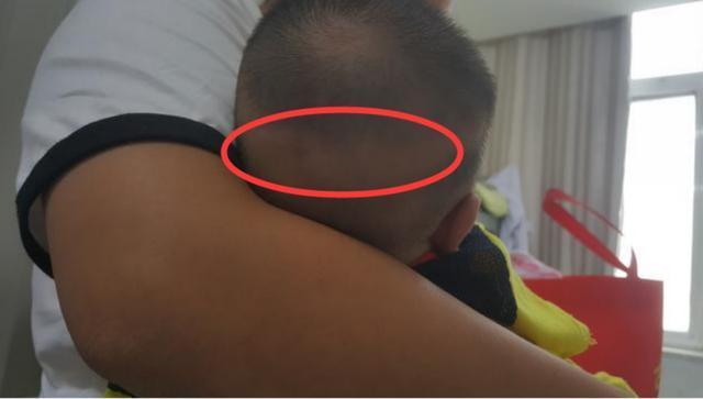 缺钙的宝宝头部一般凹凸不平且偏大,看起来头部很方,前额和后枕部都有