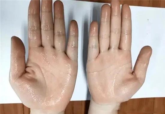 汗 原因 手 容易流汗是病嗎？中醫：異常出汗5大原因