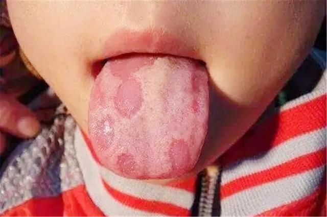 儿童花斑舌图片图片