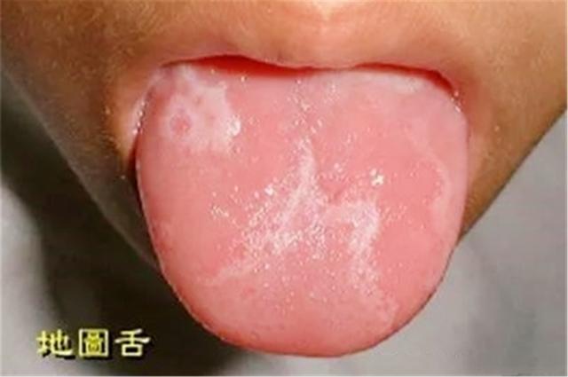孩子出现"地图舌",往往预示着身体状况不佳,尽早调理少生病