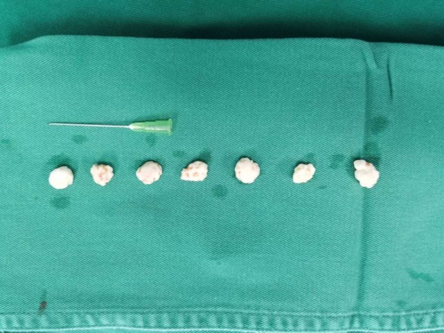 长沙女子右膝抓出7只"关节鼠" 膝盖差点报废