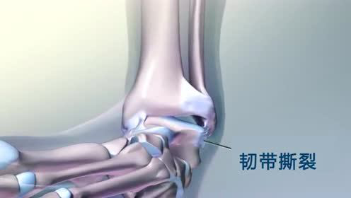 膝关节|韧带撕裂最好的治疗方法