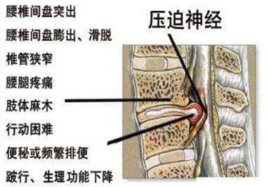 中医孔政:腰椎间盘突出压迫神经腿麻腿痛针灸怎么调理?