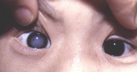 可伴发斜视,眼球震颤.