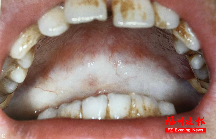 的纤维条索质地较硬阿潇软腭后以及双颊黏膜发白口腔检查结果显示随后