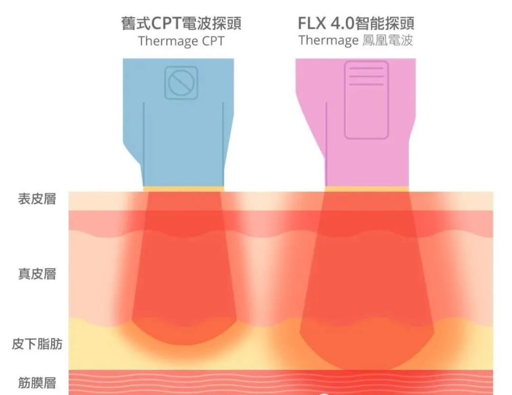 电波拉皮效果多久 打完第五代热玛吉 然后呢 腾讯新闻