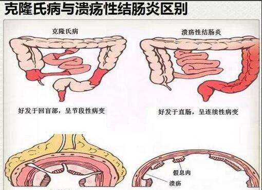克罗恩病有什么临床表现？