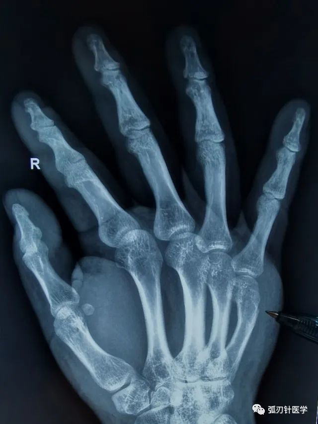 拳击骨折 不需要石膏固定 更不需要手术 石膏固定 掌指关节 固定