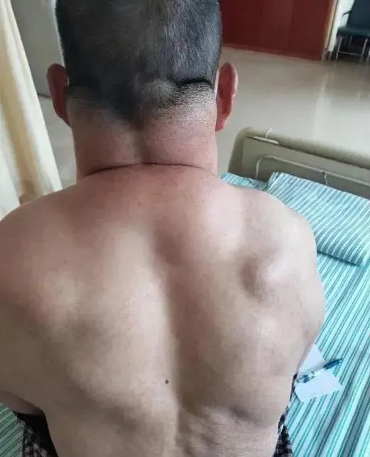 喝酒|每天2斤半！男子把它当茶喝，结果脖子比头还大！切下七八斤脂肪