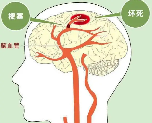 低密度脂蛋白胆固醇|为什么要降低低密度脂蛋白胆固醇？