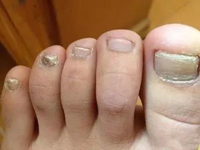 白点是有蛔虫?一篇说清指甲疑问|指甲|月牙|蛔虫