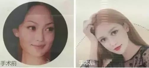 整容|00后高考完扎堆整容，中国的审美，什么时候沦落到靠整容脸来支撑了？