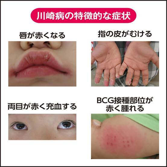 发烧的婴幼儿疾病——川崎病,也有心肌梗塞的发病危险