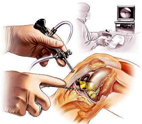 半月板撕裂进行了关节镜手术以后出现积液该咋办医生告诉您