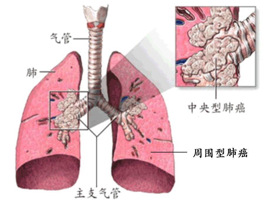 为什么肺腺癌发病率上升了一倍还说是好事这事谁知道谁受益