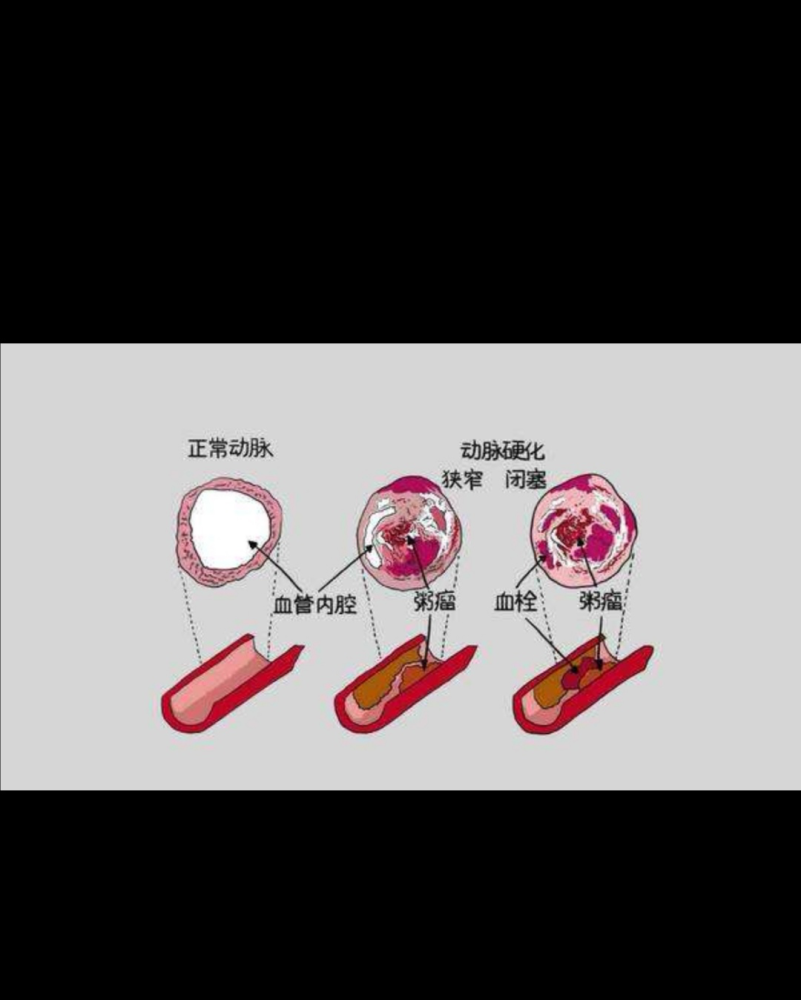 冠心病|冠心病是什么？如何预防？