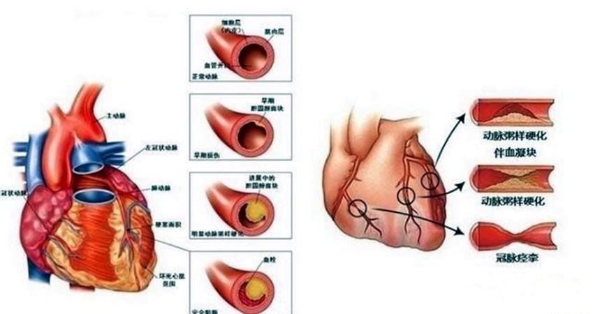冠状动脉痉挛可以发生在有动脉粥样硬化的冠状动脉,也可以发生在外观