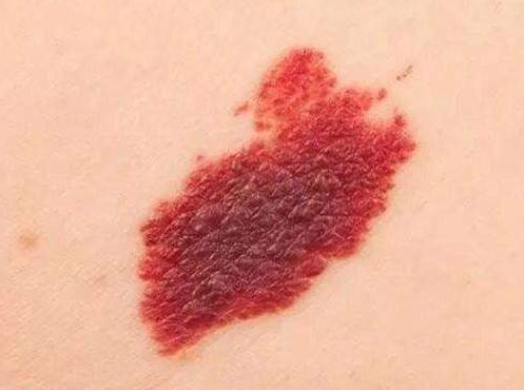 青屁股是福气这3种形状的胎记家长要格外当心