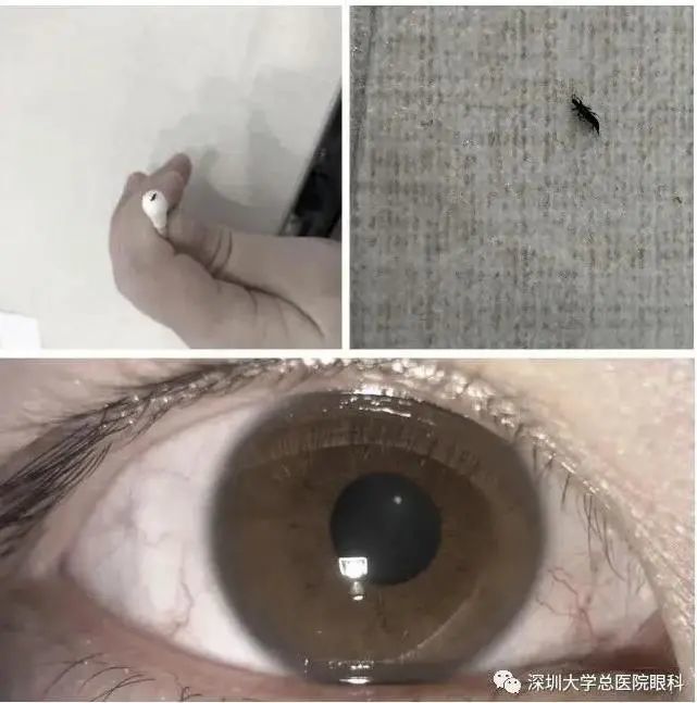 由于没有乱揉眼睛,医生一眼就看见了她的下睑穹窿部有个完整的虫体!