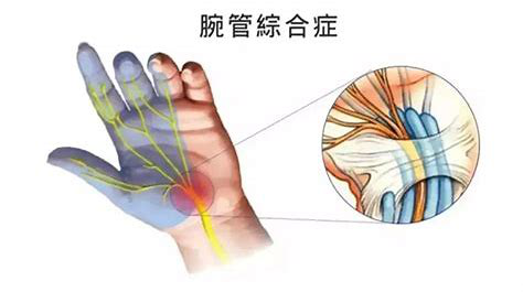 腕管综合征首先长期的不良姿势会导致手麻,长时间的对神经进行压迫会