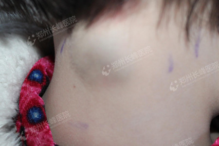 1,头痛,颅内压增高或肿瘤直接压迫刺激脑膜,血管及神经