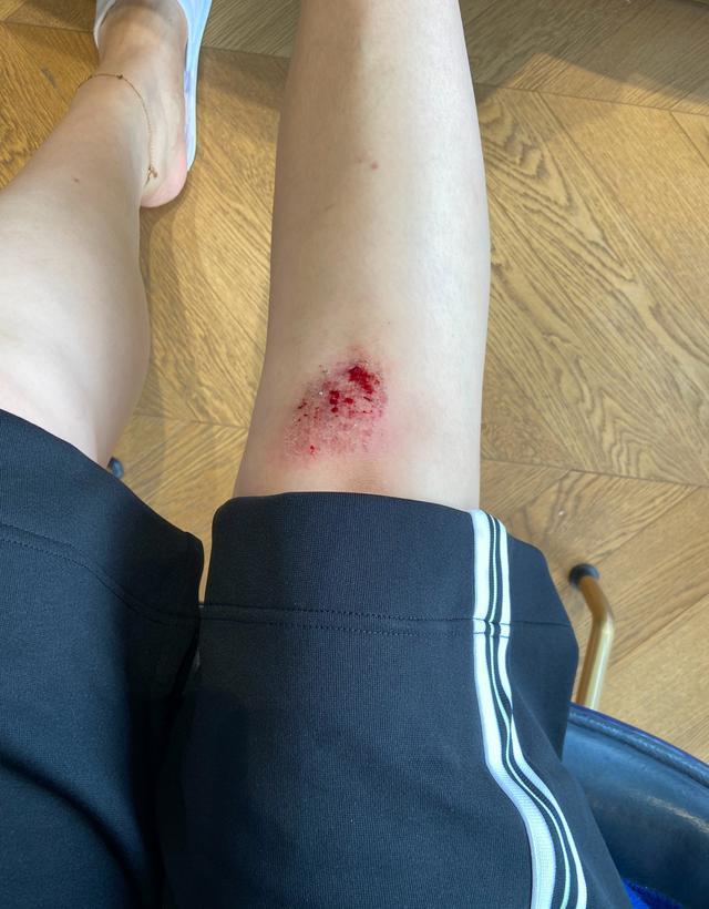 女排重炮手仍在苦苦坚持,疑似因训练而摔破膝盖_腾讯新闻