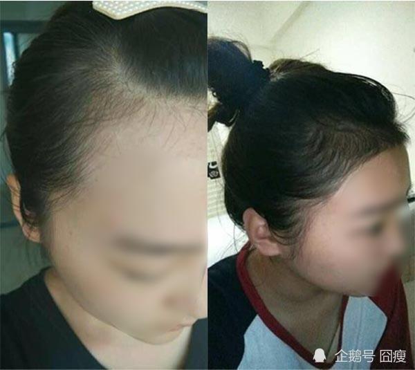 脱发|女人头发稀少了怎么办 生发密发这样做就对了