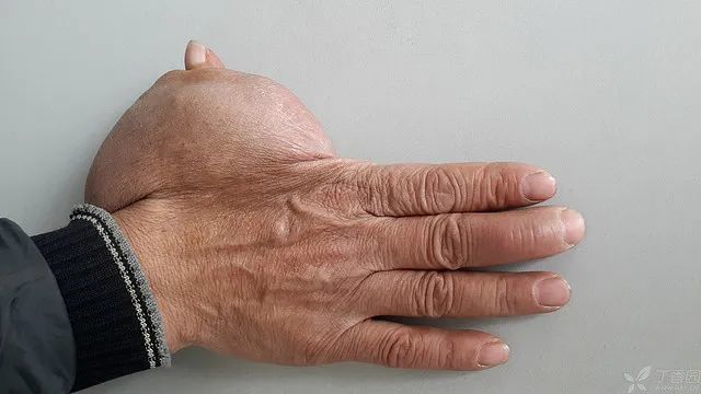 拇指巨大肿物40多年血管瘤腱鞘巨细胞瘤