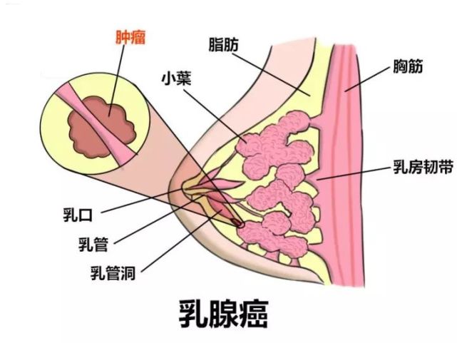 為什麼會得乳腺癌?