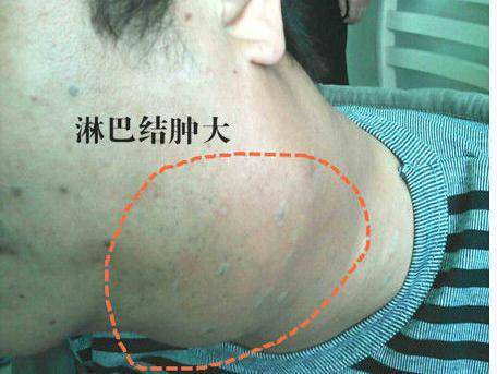 带你了解霍奇金淋巴瘤的临床表现及治疗方法