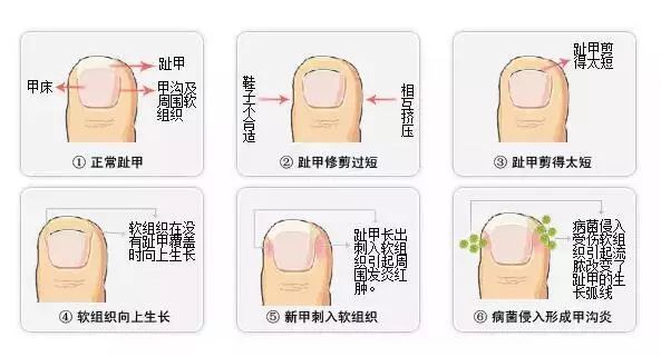 科普甲溝炎太折磨人預防甲溝炎應該這樣做