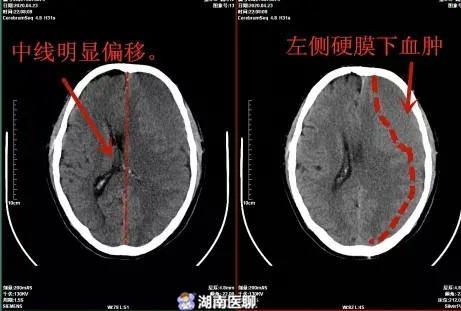 就是摔了一下，10天后大爷竟无法站立行走？