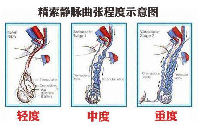 儿童精索静脉曲张为什么要手术治疗?术后如何护理?预后怎样?