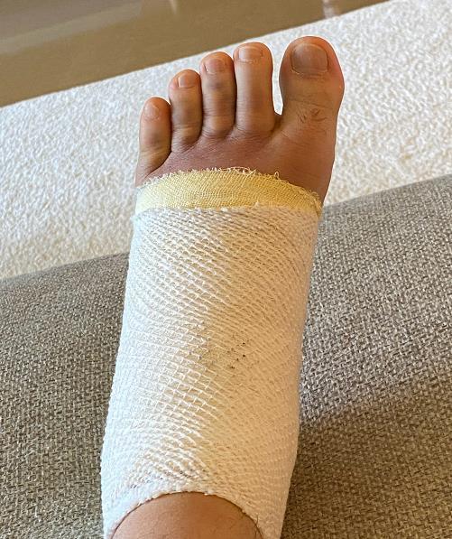 第二张照片则是庾澄庆受伤的左脚的特写了,可以看出的是庾澄庆的脚